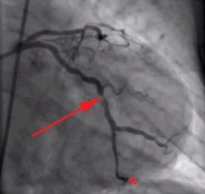 Coronary_angiography_of_a_STEMI_patient,_showing_partial_occlusion_of_left_circumflex_coronary_artery